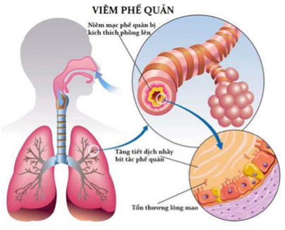 dị tật bẩm sinh, rối loạn chuyển hóa bẩm sinh, sàng lọc sơ sinh, viêm phế quản ở trẻ em